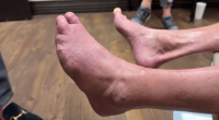 Runner loses toes before doctors discover artery blockage