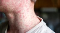 Close-up of measles rash on a person's neck and shoulder.