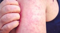 Chicago-area health officials report two new measles cases