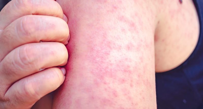 Chicago-area health officials report two new measles cases