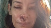 Evangeline Lilly reveals shocking facial injuries after horror fall