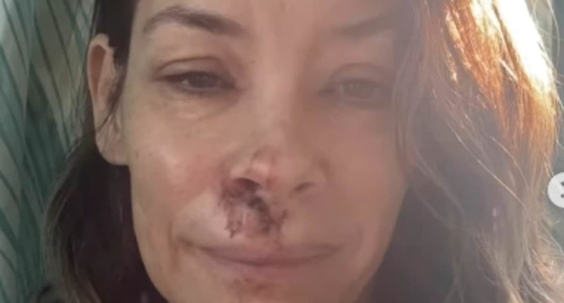 Evangeline Lilly reveals shocking facial injuries after horror fall