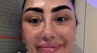 Sophie Kasaei shows off the results as she dissolves face filler