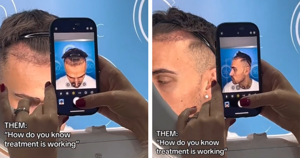 How Ben from Love Island Transformed After £3000 Hair Transplant