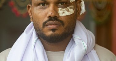 Sole survivor of an Air India plane crash with bandages on his face.