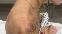 Photo of bruises and injuries on a woman's shoulder and neck.