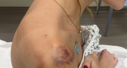 Photo of bruises and injuries on a woman's shoulder and neck.