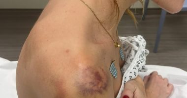 Photo of bruises and injuries on a woman's shoulder and neck.