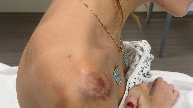 Photo of bruises and injuries on a woman's shoulder and neck.