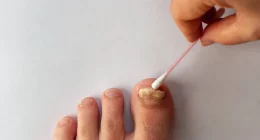 Say Goodbye to Toenail Fungus: Expert-Approved Home Solutions You Can Try Today