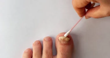 Say Goodbye to Toenail Fungus: Expert-Approved Home Solutions You Can Try Today