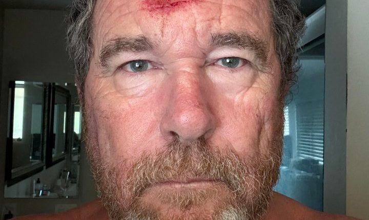 Close-up of a man's forehead with a large, red, and bloody wound.