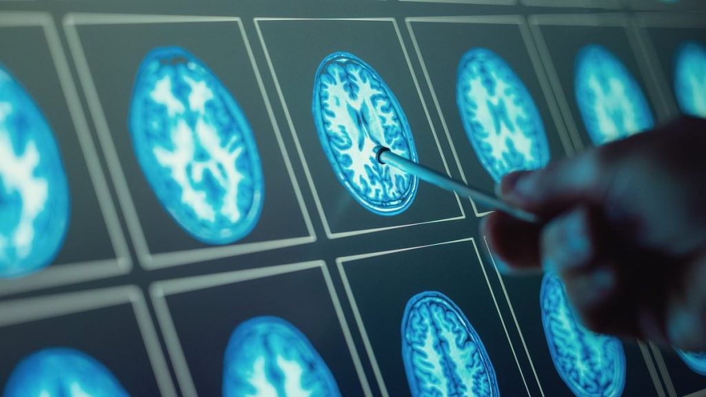 Top scientists flag little-known earliest signs of dementia