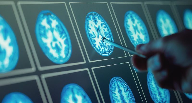 Top scientists flag little-known earliest signs of dementia