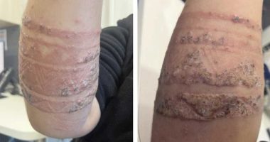 Kerrie-Anne Graf's son had a severe reaction to a 'black henna' tattoo in Bali.