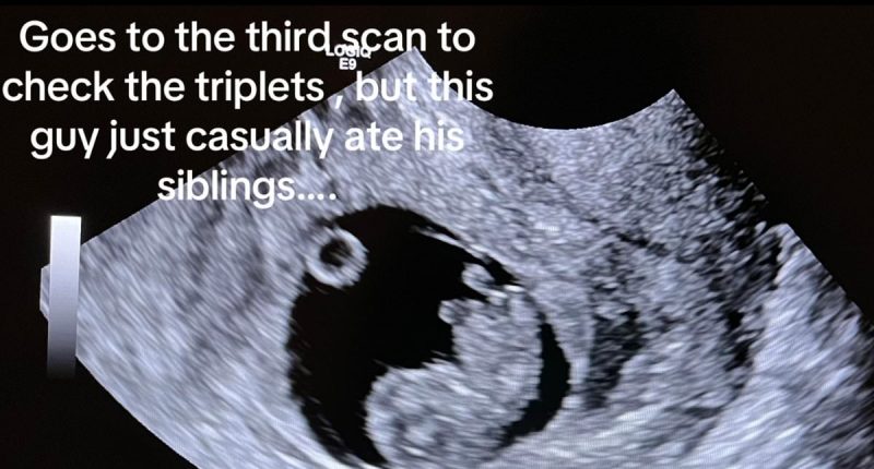 I was pregnant with triplets but only delivered one baby after my son 'ate his siblings' in the womb