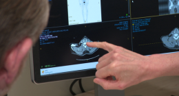 A revolution in the treatment of late-stage melanoma has been reached with clinical trial results seeing surging survival rates