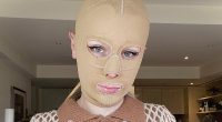Woman left with severe burns on 70 percent of her body and had eight fingers amputated after volcano eruption reveals what she looks like 5 years later