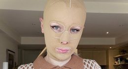 Woman left with severe burns on 70 percent of her body and had eight fingers amputated after volcano eruption reveals what she looks like 5 years later