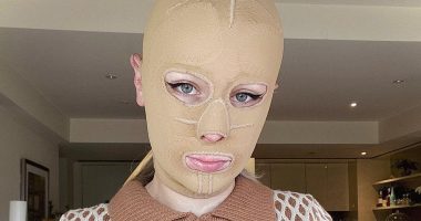 Woman left with severe burns on 70 percent of her body and had eight fingers amputated after volcano eruption reveals what she looks like 5 years later