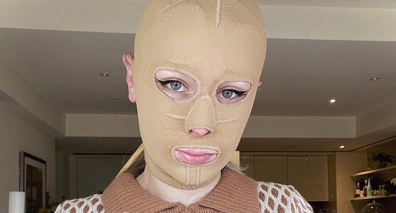 Woman left with severe burns on 70 percent of her body and had eight fingers amputated after volcano eruption reveals what she looks like 5 years later