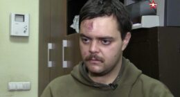 Aiden Aslin, a British fighter for Ukraine, with a head wound.