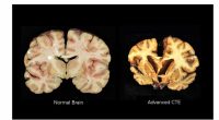 CTE, brain disease linked to repeated head injuries