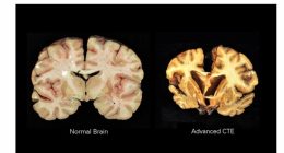 CTE, brain disease linked to repeated head injuries