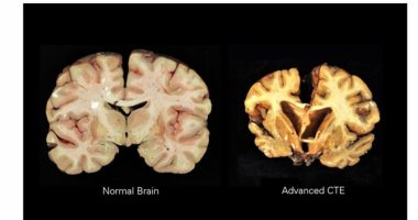 CTE, brain disease linked to repeated head injuries