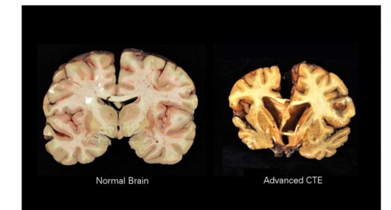 CTE, brain disease linked to repeated head injuries