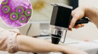 Doctors using herpes to fight untreatable advanced cancer