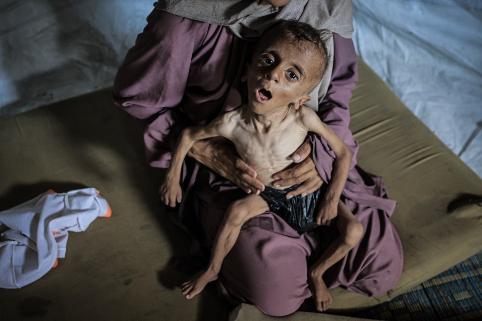 Severely malnourished child held by a woman.
