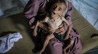 Severely malnourished child held by a woman.