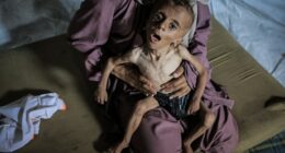 Severely malnourished child held by a woman.