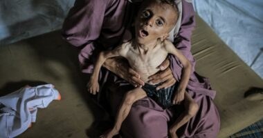 Severely malnourished child held by a woman.