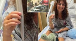 Jersey shore lifeguard impaled by umbrella is back at the beach