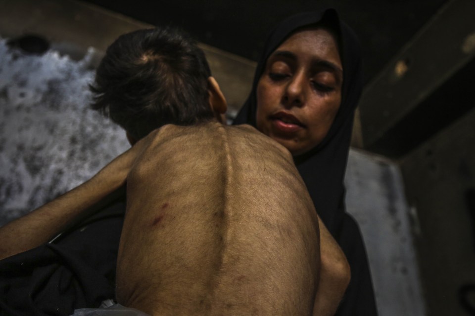 Malnourished child held by a woman.