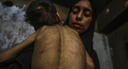 Malnourished child held by a woman.