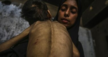 Malnourished child held by a woman.