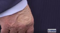 Concerning markings appear across Trump's body. Now experts reveal what they really are