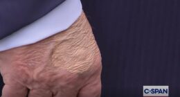 Concerning markings appear across Trump's body. Now experts reveal what they really are