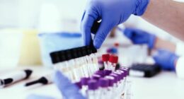 Landmark genetic study aims to find root cause of debilitating disease