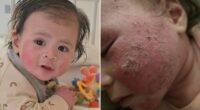 Nikki's baby had a common rash. But treatment withdrawal was worse