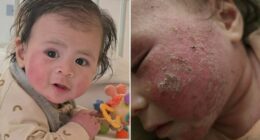 Nikki's baby had a common rash. But treatment withdrawal was worse