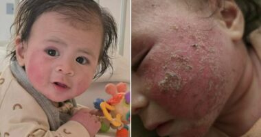Nikki's baby had a common rash. But treatment withdrawal was worse