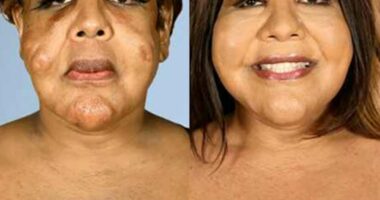 These Botched Plastic Surgery Before-and-After Pics Will Shock You