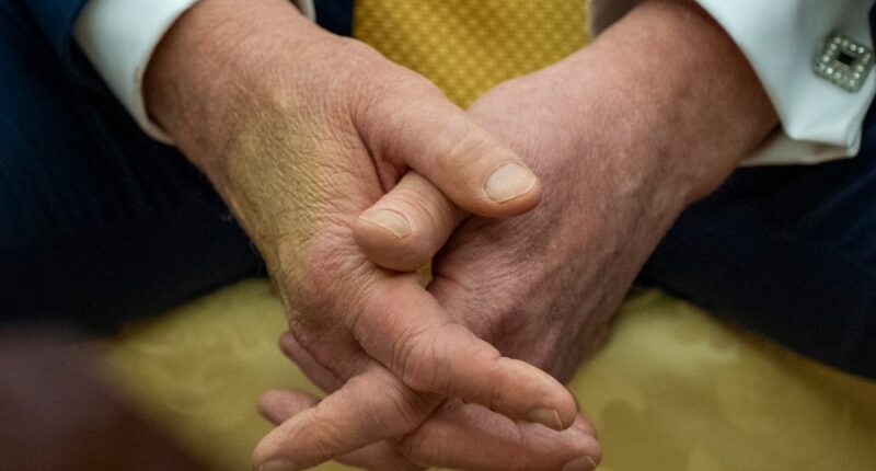 Trump is checked for lower leg swelling and diagnosed with a common condition in older adults