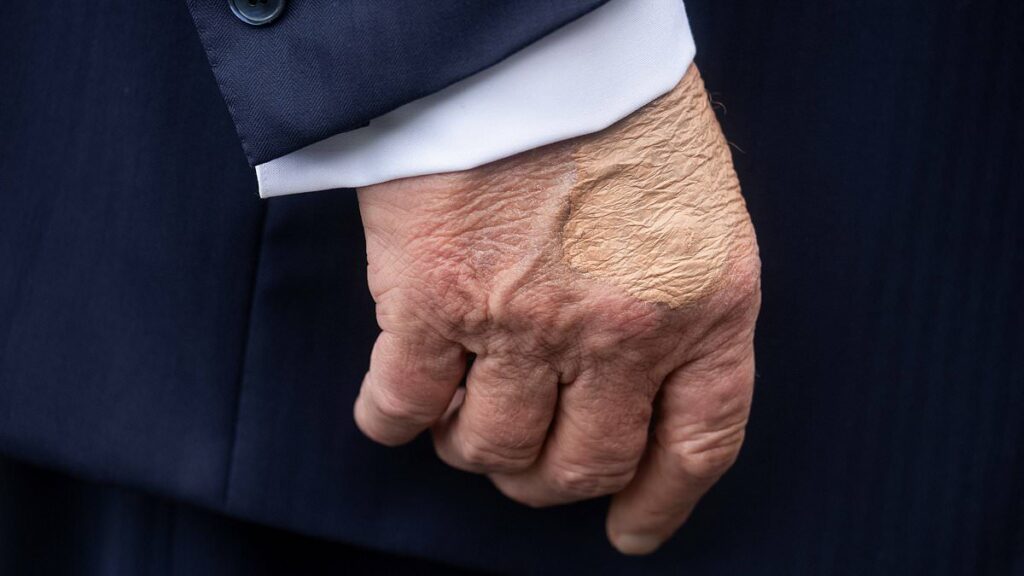 White House reveals Trump's 'chronic' health condition as he suffers swelling and bruises