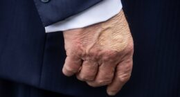 White House reveals Trump's 'chronic' health condition as he suffers swelling and bruises