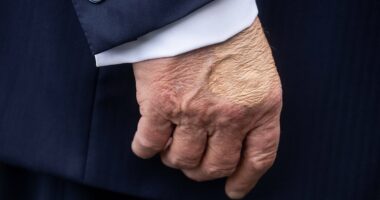 White House reveals Trump's 'chronic' health condition as he suffers swelling and bruises